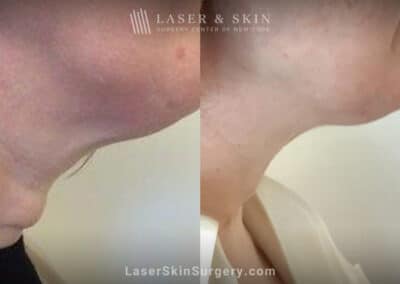 ThermiTight for Neck Rejuvenation