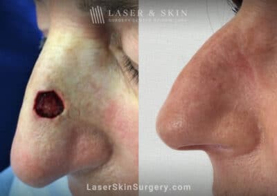 Mohs surgery to treat skin cancer on the nose