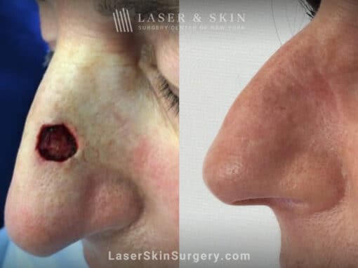 Mohs surgery to treat skin cancer on the nose