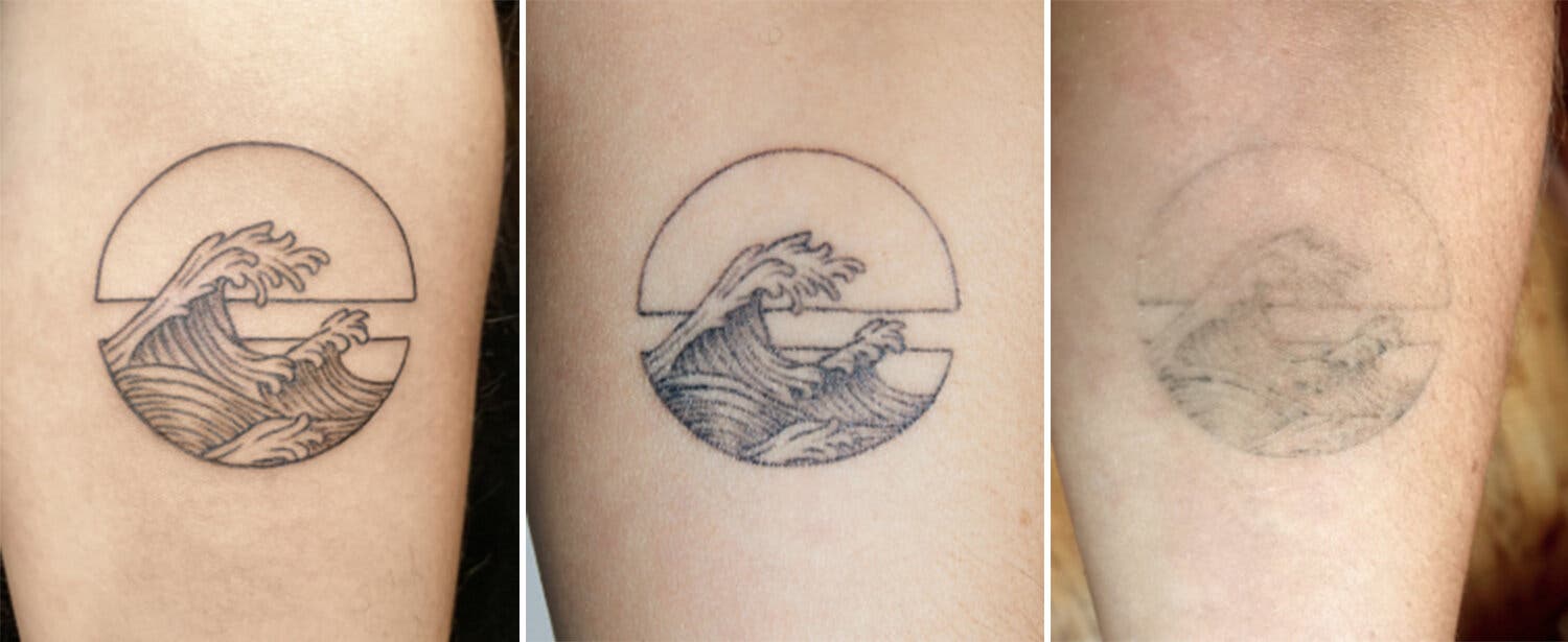 LSSC-geronemus-how-do-you-feel-about-tattoos laser tattoo removal results