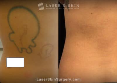 5 PicoSure treatments to remove back tattoo