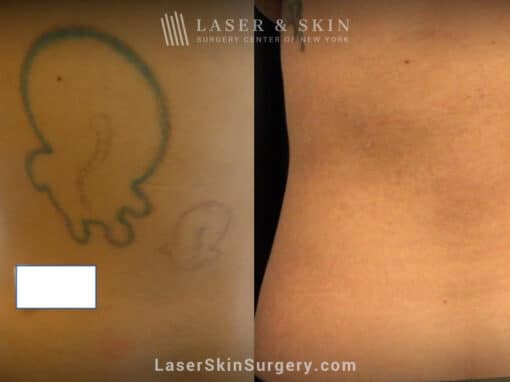 5 PicoSure treatments to remove back tattoo