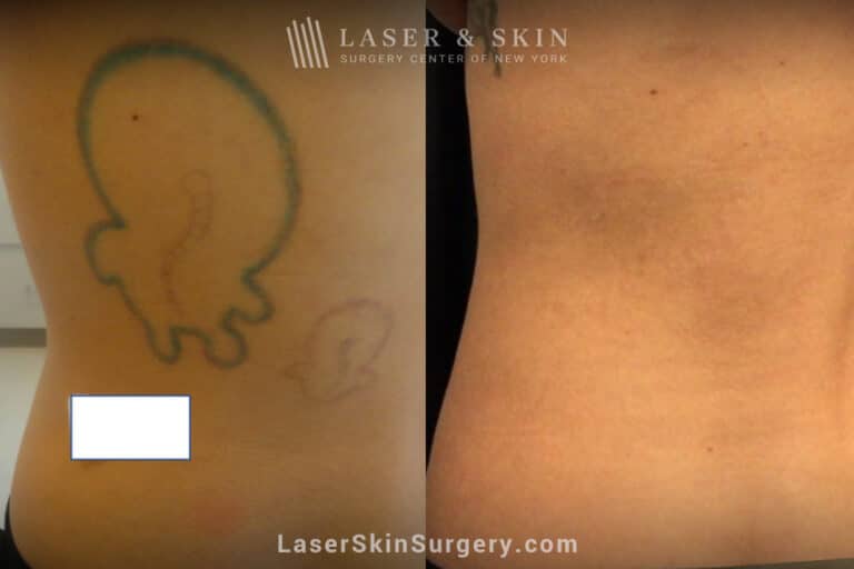 5 PicoSure treatments to remove back tattoo