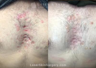 2 Fraxel Repair laser treatments for chest acne scars