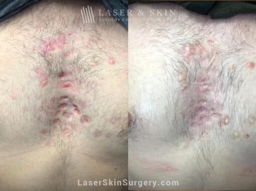 2 Fraxel Repair laser treatments for chest acne scars