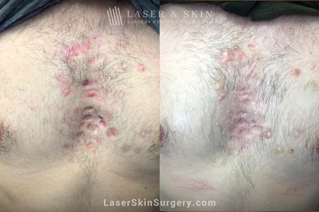 scar treatment before and after