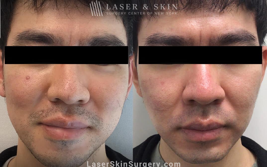 Fraxel laser to treat enlarged pores on the nose