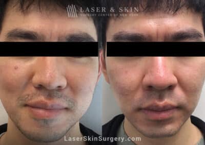 Fraxel laser to treat enlarged pores on the nose