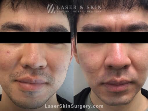 Fraxel laser to treat enlarged pores on the nose