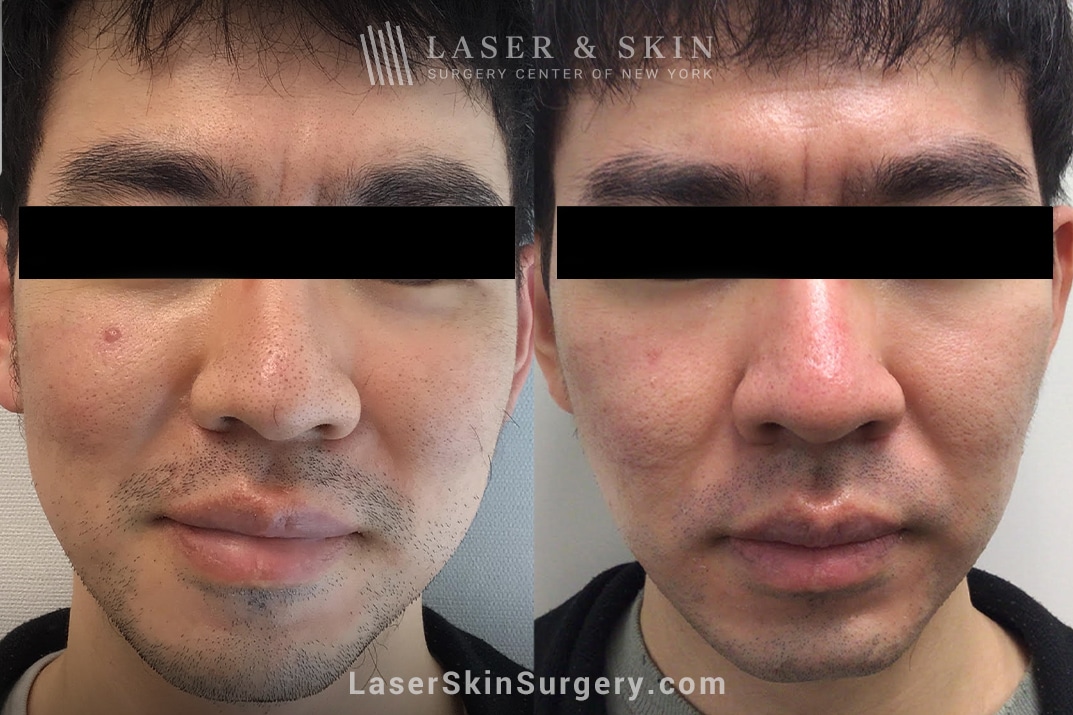 LSSCNY-NYC-Fraxel-laser-for-nose-pores