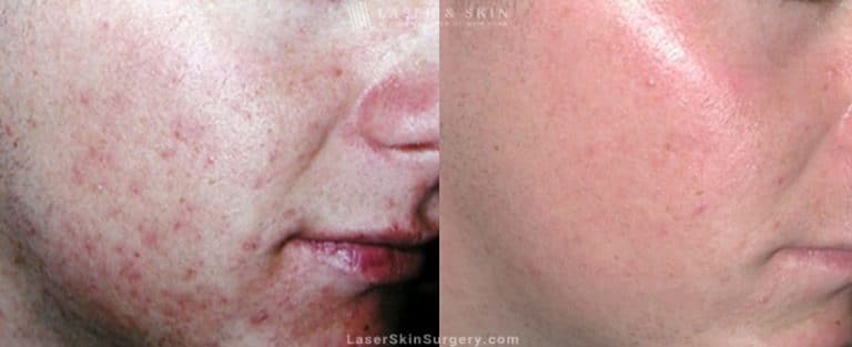 Laser Treatment Acne Scars New York, NY before and after image of a laser treatment for acne scars on a young mans face