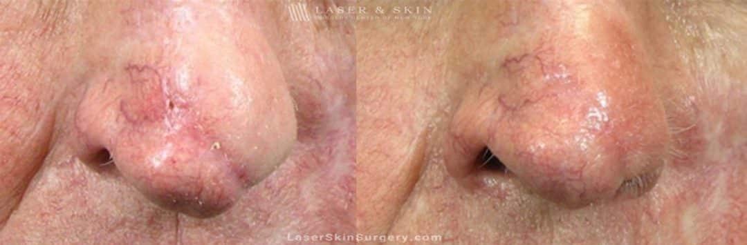 Laser Treatment for Scar Removal Nose Mohs Surgery New York, NY image of a before and after for laser treatment to remove a scar on a man's nose post mohs surgery