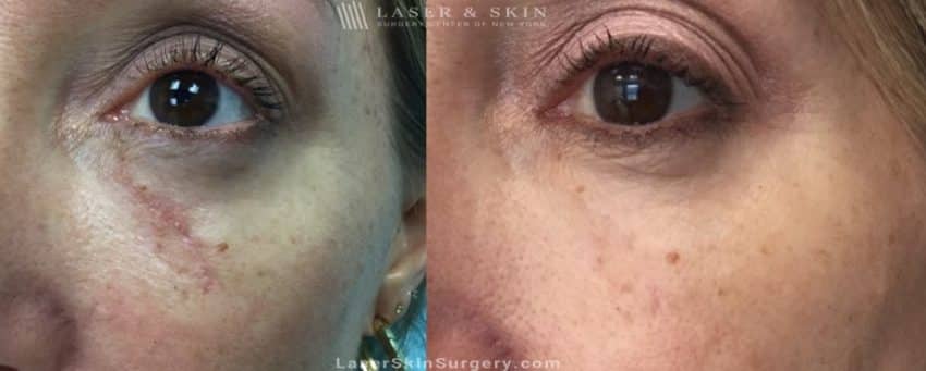 before and after image of a laser treatment for scar removal on a woman's face under the eye