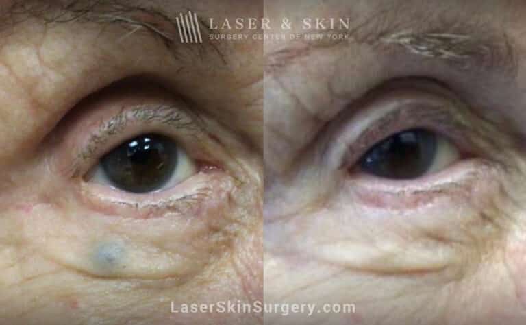 Excel V treatment for lesion on the right cheek