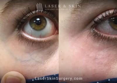 Excel V laser to treat veins under the eye