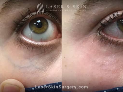 Excel V laser to treat veins under the eye