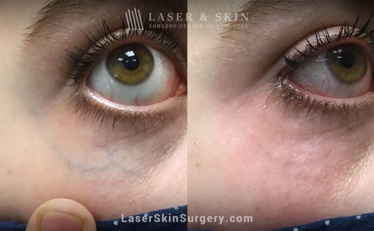 Excel V laser to treat veins under the eye