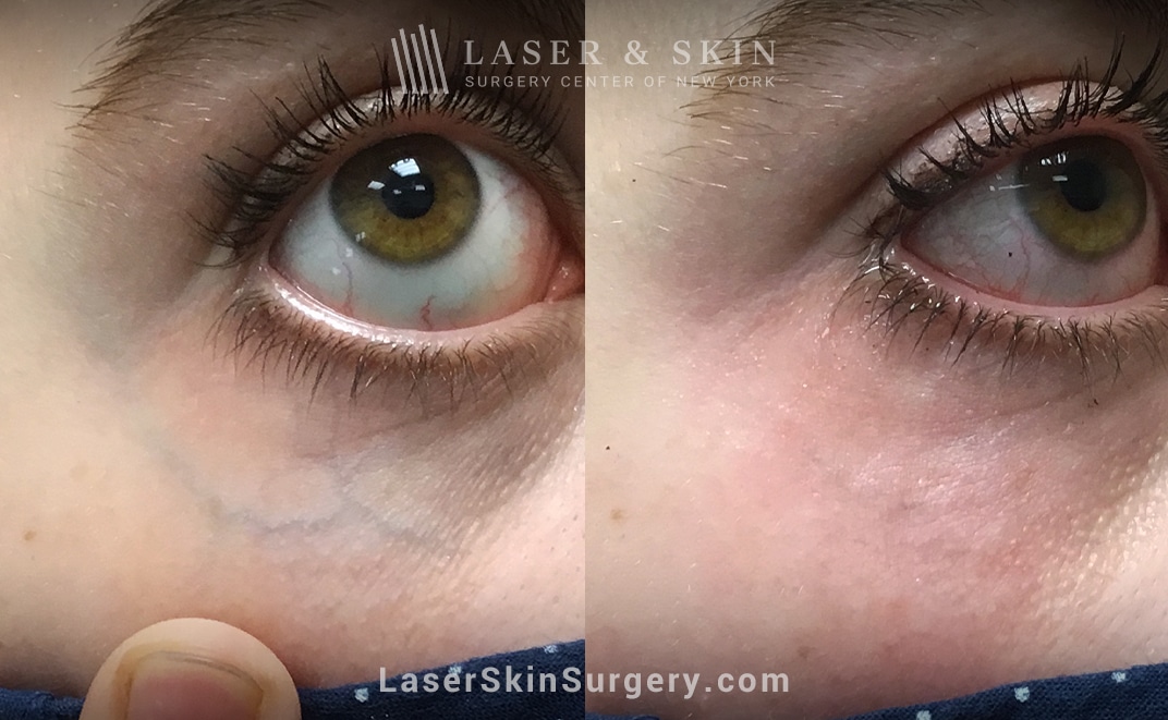 LSSCNY-NYC-excel-v-laser-under-eye-treatment Laser and Skin Surgery Center of New York before and after results of an actinic keratoses treatment in NYC