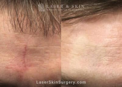 Fraxel laser to treat scar on forehead after Mohs surgery