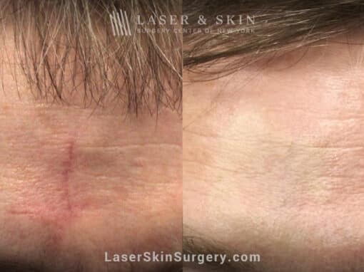 Fraxel laser to treat scar on forehead after Mohs surgery