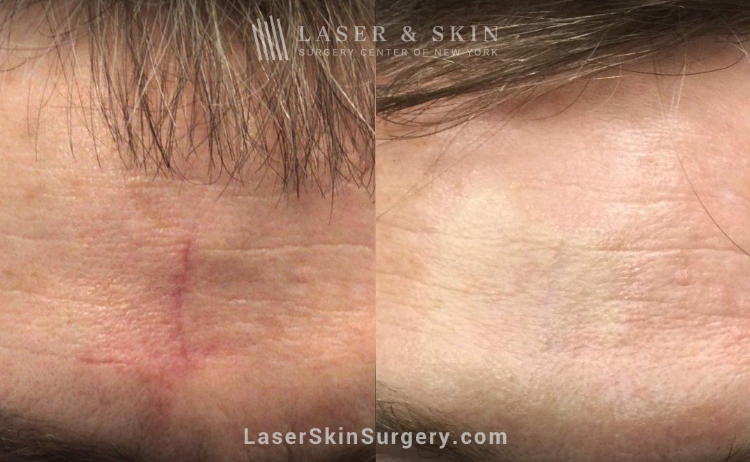 laser scar removal before and after