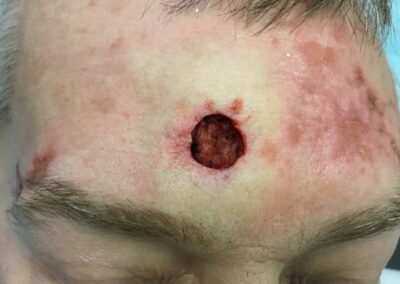 Mohs surgery to treat skin cancer on the forehead