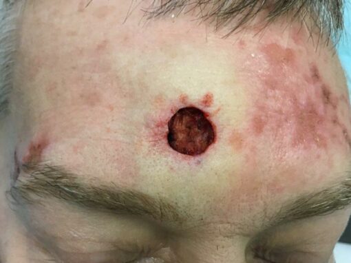 Mohs surgery to treat skin cancer on the forehead