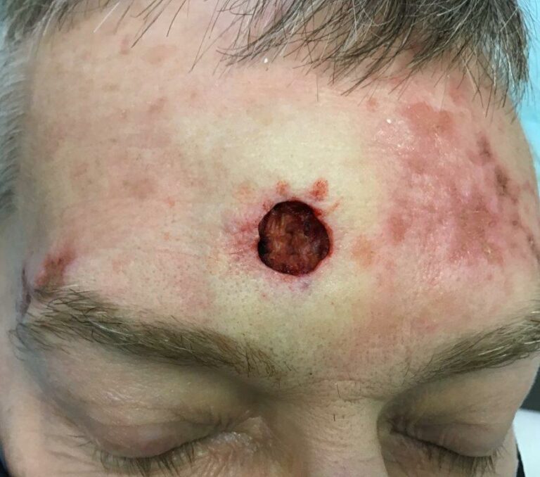 Mohs surgery to treat skin cancer on the forehead