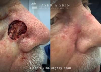 Mohs surgery to treat skin cancer on the nose