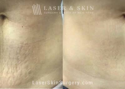 Microneedling RF and Alastin to reduce the appearance of abdominal stretch marks