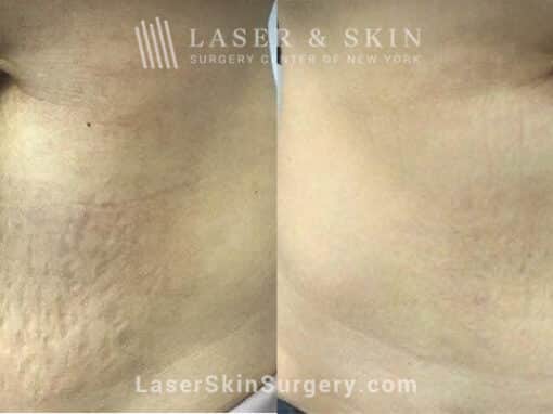 Microneedling RF and Alastin to reduce the appearance of abdominal stretch marks