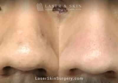 3 Erbium Laser Treatments to Remove Scar on Nose