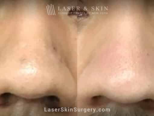 3 Erbium Laser Treatments to Remove Scar on Nose