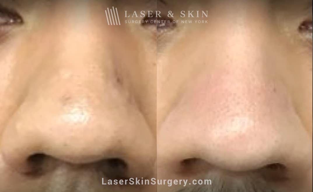 3 Erbium Laser Treatments to Remove Scar on Nose