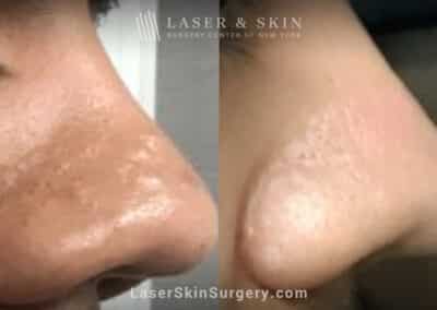 3 Erbium Laser Treatments to Remove Scar on Nose