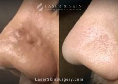 3 Erbium Laser Treatments to Remove Scar on Nose