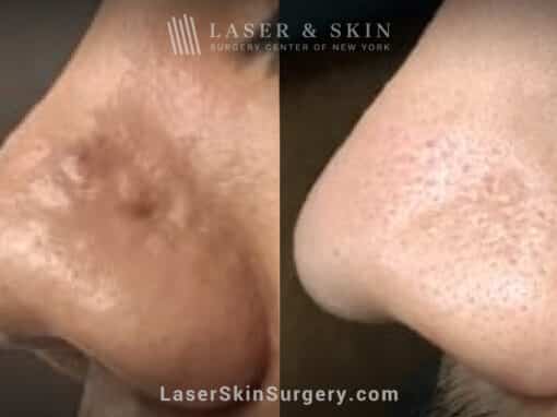 3 Erbium Laser Treatments to Remove Scar on Nose