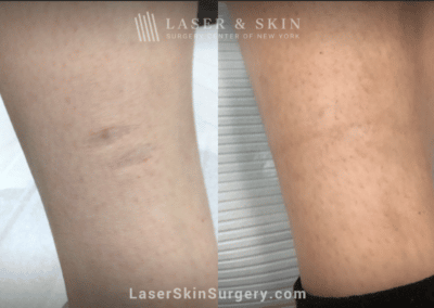 One Fraxel Repair treatment to minimize scar