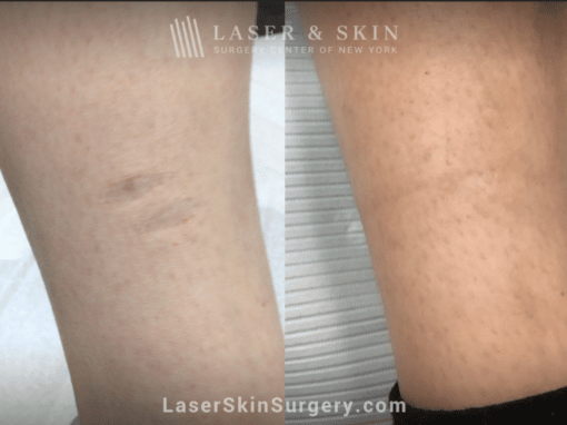 One Fraxel Repair treatment to minimize scar