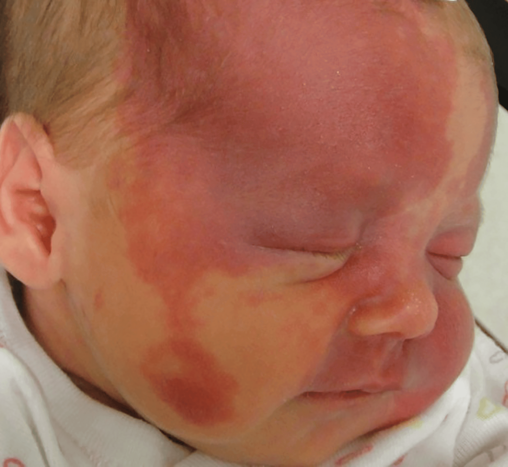 infant with a vascular birthmark in NYC