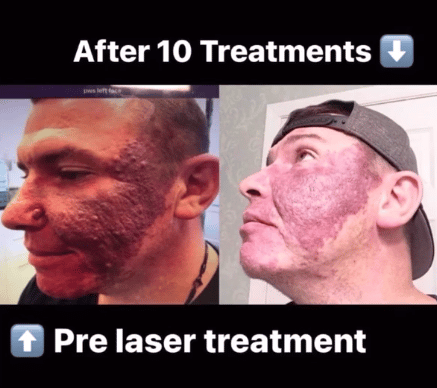 vasular birthmark laser treatment-NY-NY before and after vascular birthmark treatment in NY, NY