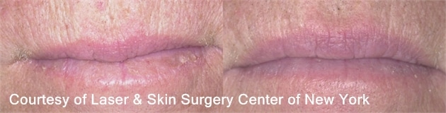 before and after results of an actinic cheilitis treatment in NY, NY