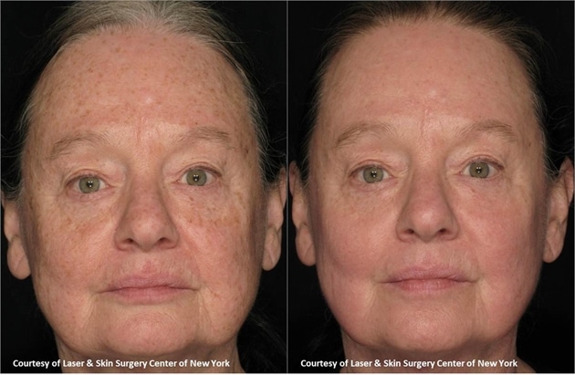 Actinic Keratoses- NYC-NY before and after results of an actinic keratoses treatment in NYC
