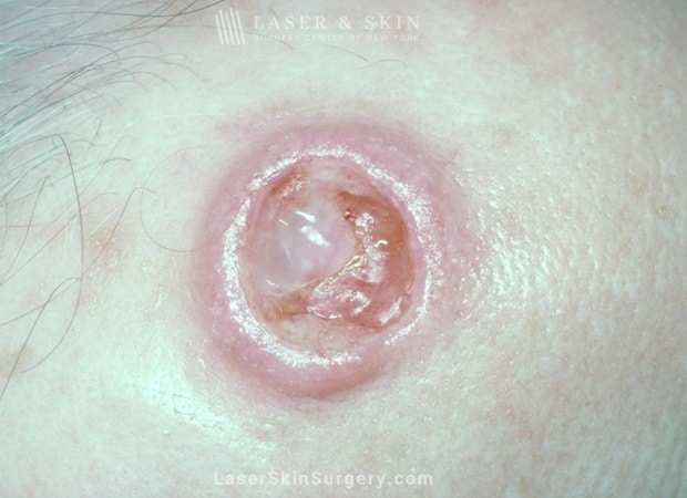 different types of skin cancer-NYC image of squamous cell carcinoma