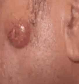 forms of skin cancer-NY-NY image of merkel cell carcinoma