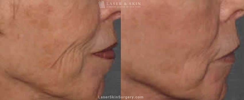 before and after results from a laser resurfacing treatment in NYC