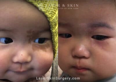 Laser treatment to remove birthmark from under infant’s eye