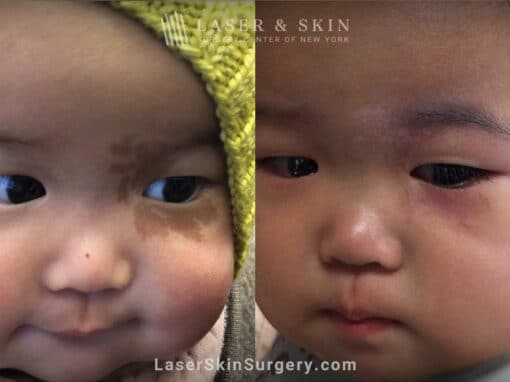 Laser treatment to remove birthmark from under infant’s eye