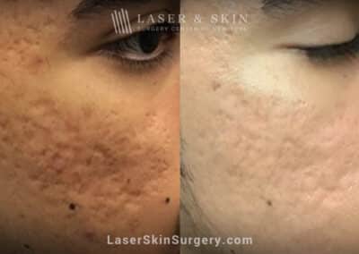 Fraxel Repair Treatment for Acne Scarring