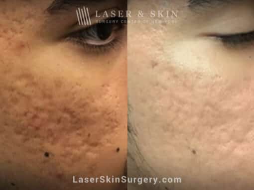 Fraxel Repair Treatment for Acne Scarring